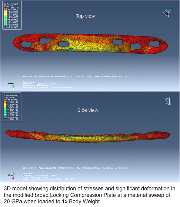 Finite element analysis of bone and implant stresses for customized  3D-printed orthopaedic implants in fracture fixation