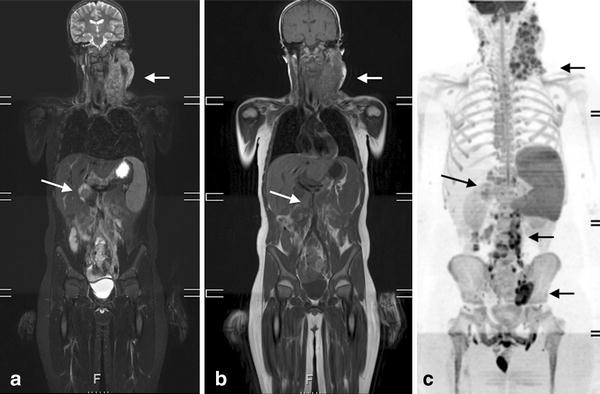 Whole-body MRI in paediatric oncology | La radiologia medica