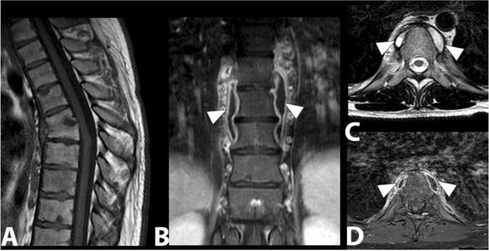 MRI of the dorso-lumbar spine showing a partial collapse of the D12