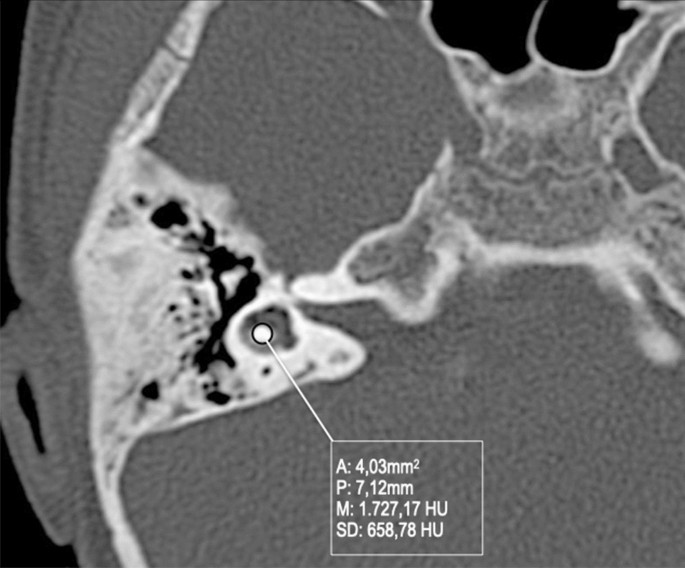 X-Linked Stapes Gusher: CT Findings in One Patient