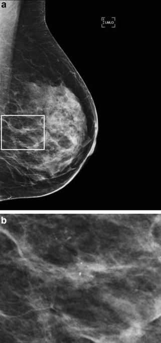 Mammographic microcalcifications and risk of breast cancer
