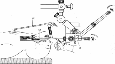 Suspension laryngoscopy using a curved-frame trans-oral robotic system |  International Journal of Computer Assisted Radiology and Surgery
