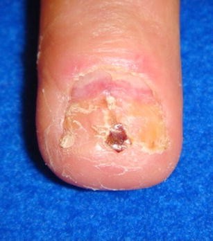 melanotic whitlow pictures Subungual tumors | HAND