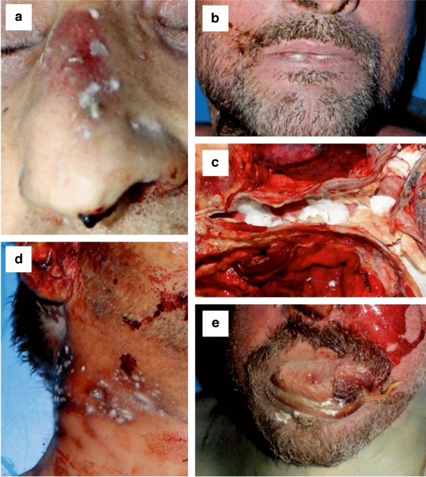 Exploring the diversity of culturable fungi on corpses for forensic applications