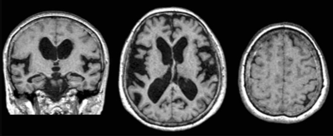 Diagnostic imaging of dementia with Lewy bodies, frontotemporal lobar  degeneration, and normal pressure hydrocephalus | Japanese Journal of  Radiology