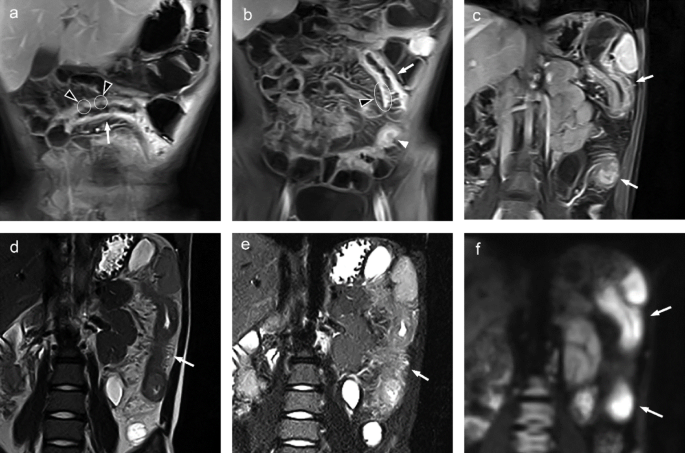 Clinical utility of magnetic resonance enterography for pediatric Crohn’s disease: a review with illustrative cases and a focus on Japan