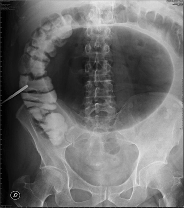 Giant Diverticulum of the Sigmoid Colon | Journal of Gastrointestinal  Surgery