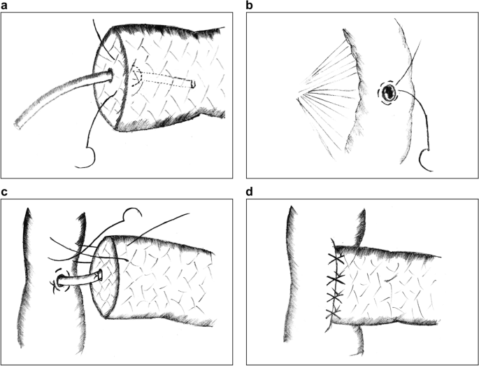 Technique of femoral access with purse-string sutures and Rummel's... |  Download Scientific Diagram
