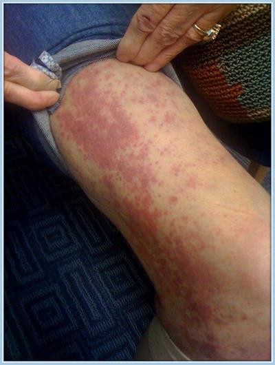 vitamin c lipid rash Vitamin C Deficiency in an Anticoagulated Patient | Journal of General  Internal Medicine