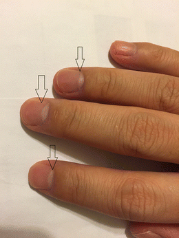 Terry's Nails and Lindsay's Nails: Two Nail Abnormalities in Chronic  Systemic Diseases | Journal of General Internal Medicine