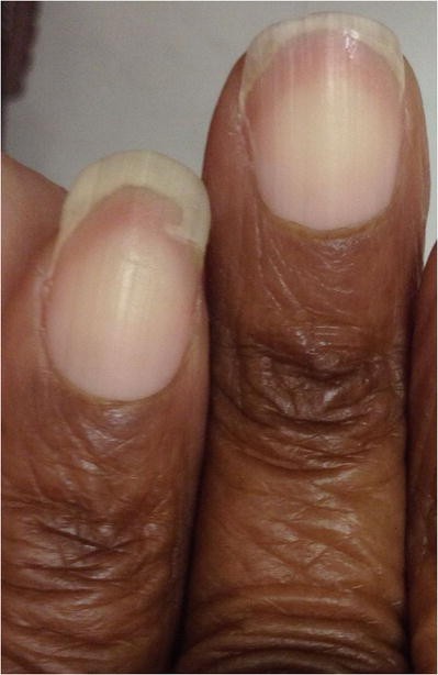 Nail abnormalities in images