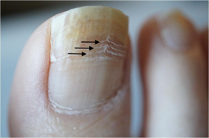 Many horizontal lines on toenails. Weak brittle nails. : r/NailFungus