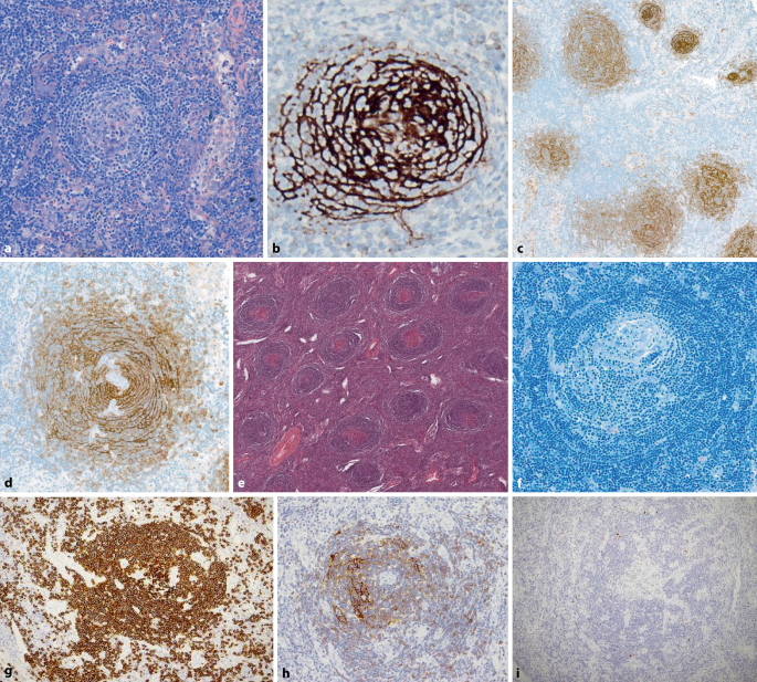 Morbus Castleman – ein seltenes, heterogenes Krankheitsbild | best practice  onkologie