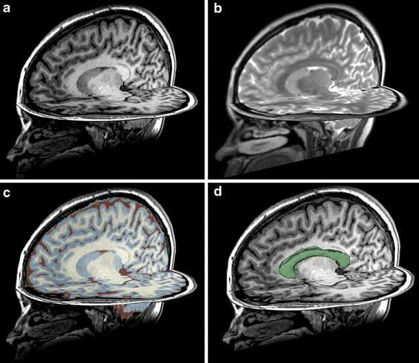 Diffusion Tensor Imaging in Traumatic Brain Injury, Neuropsychology