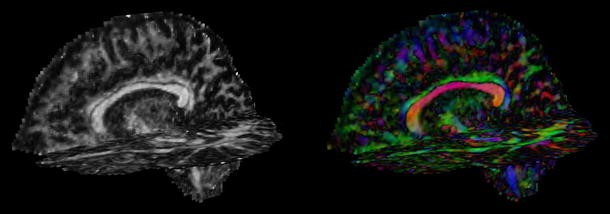 Diffusion Tensor Imaging in Traumatic Brain Injury, Neuropsychology