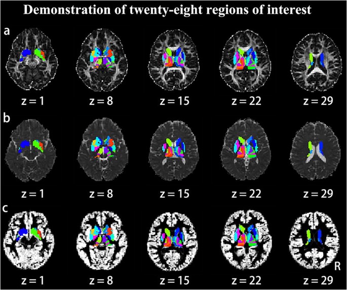 Large-scale analysis of structural brain asymmetries in schizophrenia via  the ENIGMA consortium