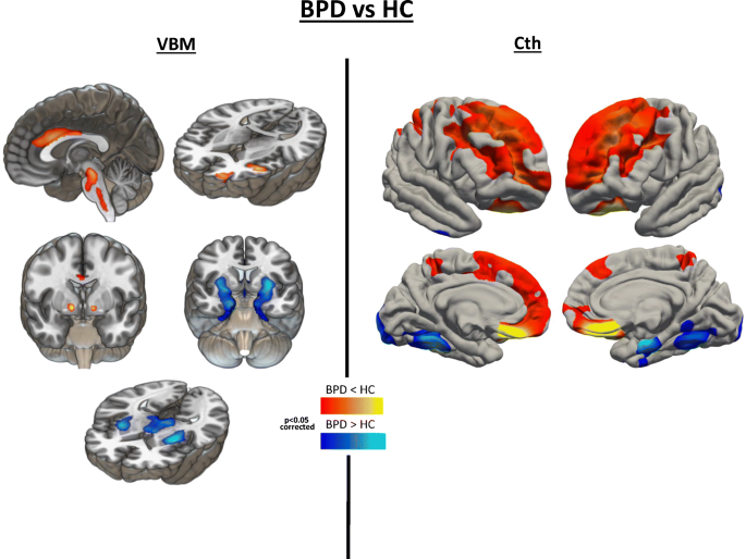 Key Brain Activity Absent in Borderline Personality Disorder - Neuroscience  News