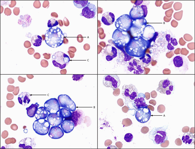 Strategies in Managing Naegleria fowleri