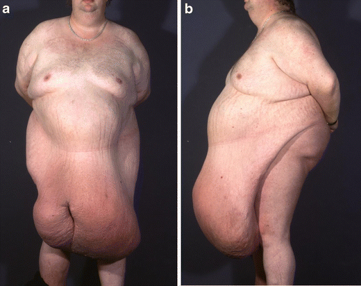 Dealing with the Mass: A New Approach to Facilitate Panniculectomy