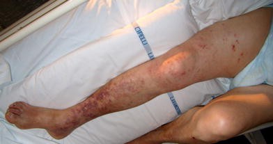 Herpetic leg paralysis and abdominal ileus in a patient with idiopathic  myelofibrosis | Internal and Emergency Medicine