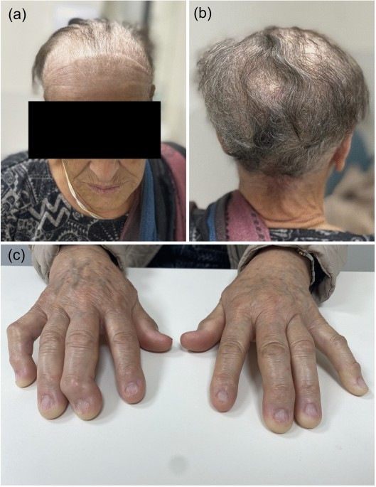 Alopecia (a) and evidence of dystrophic changes in the fingernails (b)... |  Download Scientific Diagram