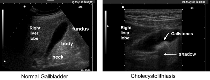 is glutathione good for gallbladder Metabolic dysfunction-associated gallstone disease: expecting more from  critical care manifestations | Internal and Emergency Medicine