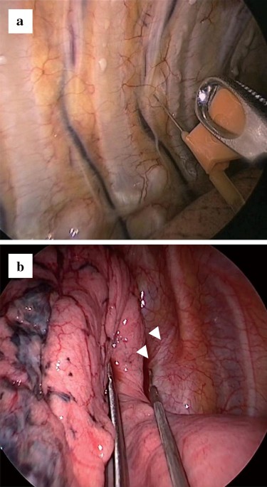 Basic Principles and Advanced VATS Procedures