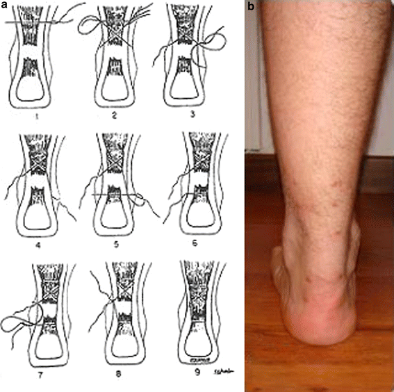 The repair of the Achilles tendon rupture: comparison of two ...