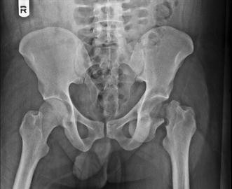 Bilateral central fracture-dislocation of hips after myelography