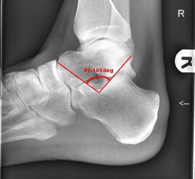 How to assess and treat calcaneal stress fractures with Tom Goom (Running  Physio) - YouTube