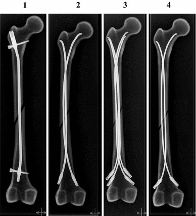 Cureus | Treatment of Diaphyseal Fractures of the Femur in Paediatric Age  Group: A Comparative Study of Locking Compression Plate Versus Titanium  Elastic Nailing System (TENS)