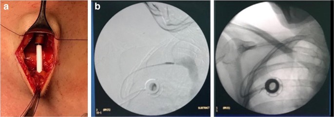 Intraoperative ipsilateral subclavian port catheter implantation