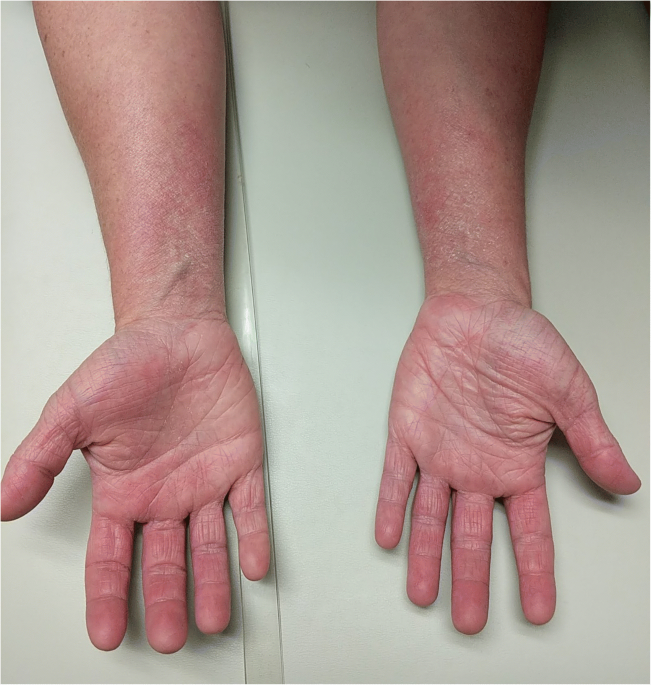 PDF] Allergic Contact Dermatitis of the Foot after use of Mastisol® Skin  Adhesive: A Case Report