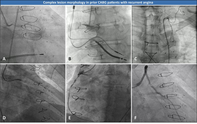 Critical Analysis of Coronary Artery Bypass Graft Surgery: A 30