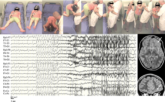 Nocturnal Seizures - Seizures during Sleep - Epilepsy Action Australia