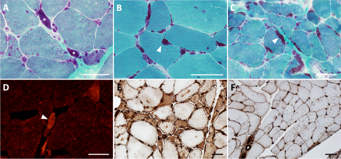 Molecular signatures of inherited and acquired sporadic late onset