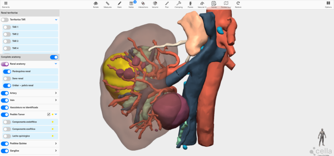 Three-Dimensional Virtual Models in Robot Assisted Partial Nephrectomy: A Needed Tool in the Era of Precision Surgery