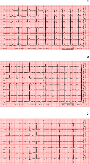 Is Borderline ECG Dangerous? Understanding Your ECG Reports