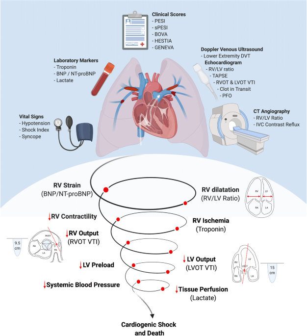 Acute DVT Treatment  Vascular Institute of The Rockies