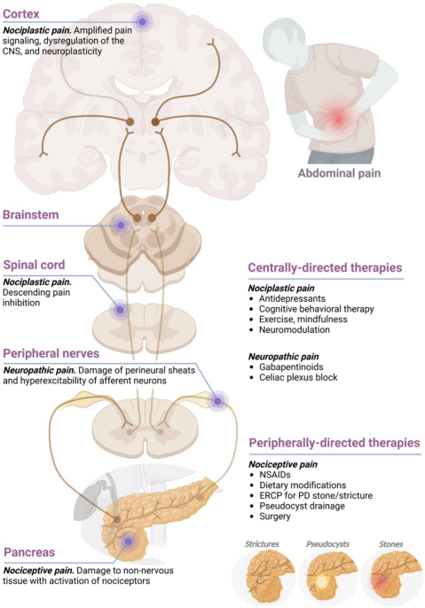 semaglutide pancreatitis law firm in michigan Precision Medicine Treatment for Painful Chronic Pancreatitis | Current  Treatment Options in Gastroenterology