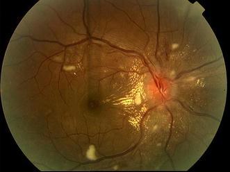 Bilateral Papillophlebitis in a Patient with Accelerated Essential  Hypertension | Annals of Ophthalmology
