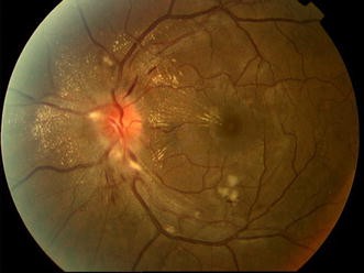 Bilateral Papillophlebitis in a Patient with Accelerated Essential  Hypertension | Annals of Ophthalmology