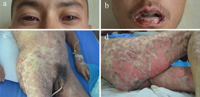 glutathione iv allergic reactions burn Sunburn Relief with Fluids Allergies explained