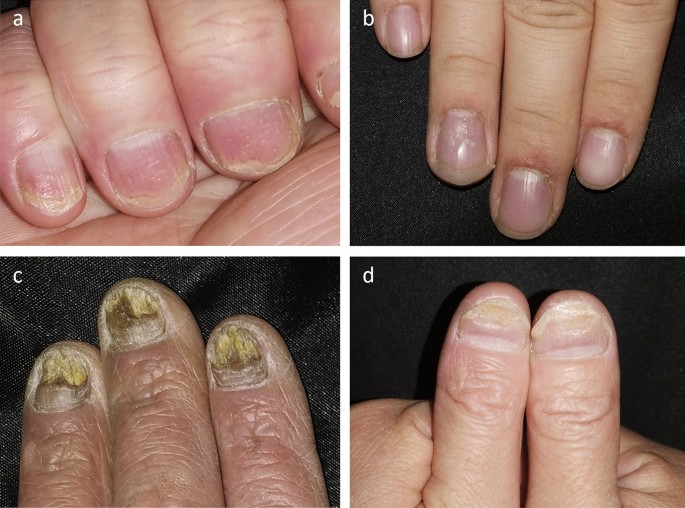 Nail manifestations seen in nail psoriasis. Nail bed features a... |  Download Scientific Diagram