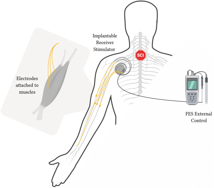 Functional Electrical Stimulation (FES) - Physiotherapy for Kids