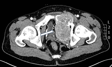 osteíte fibrosa cística radiografia