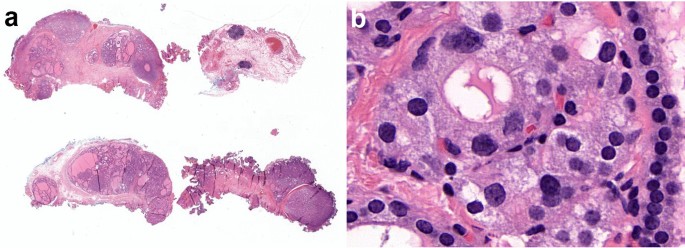 tirzepatide help with inflammation Tirzepatide as potential treatment for lipedema