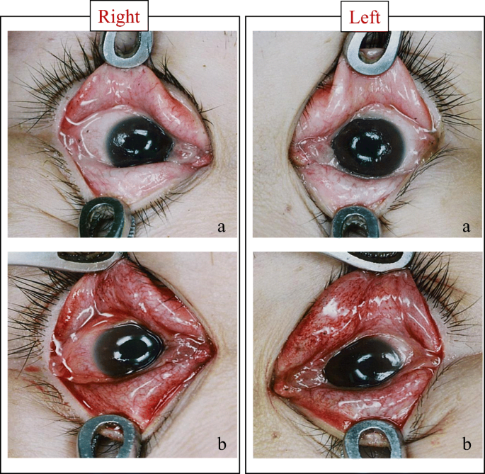 Effects of postmortem positional changes on conjunctival petechiae |  Forensic Science, Medicine and Pathology