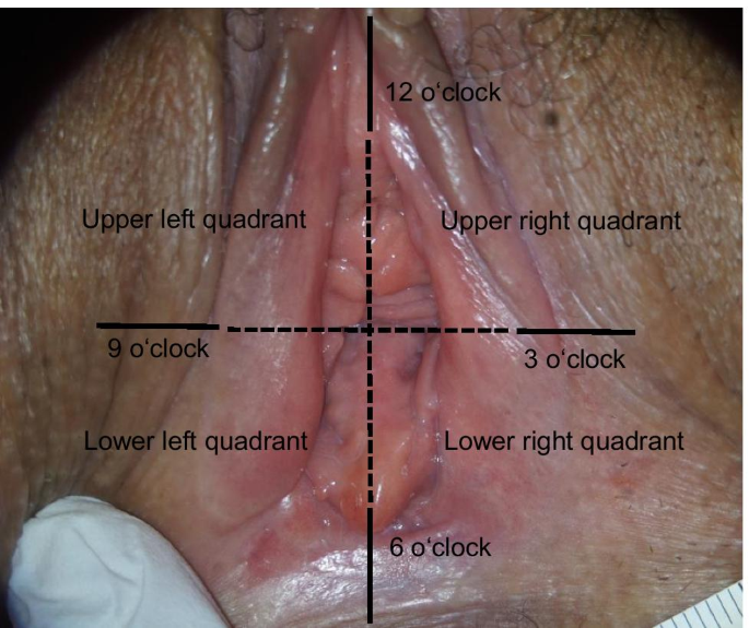Female genital injury—which findings have to be considered physiological  using colposcopy with and without toluidine blue dye? | Forensic Science,  Medicine and Pathology