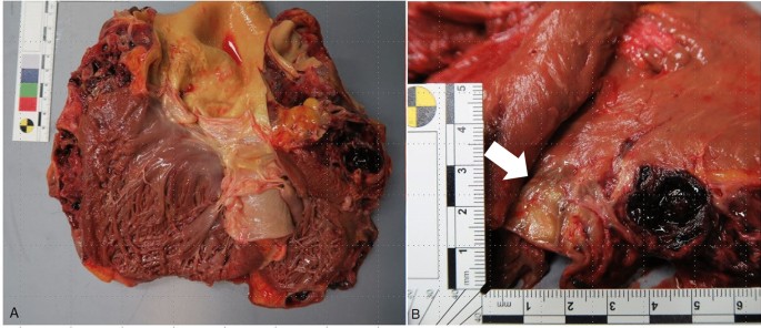 melanotic sarcoma heart Lethal complication of a rare cardiac tumor | Forensic Science, Medicine  and Pathology